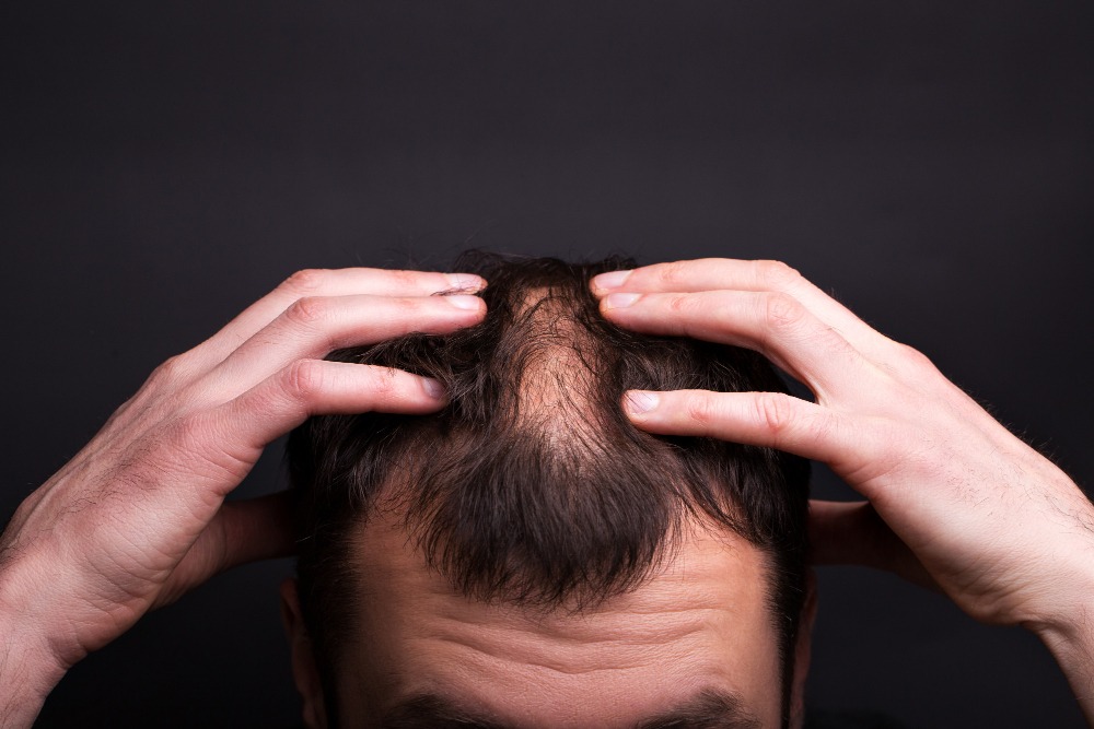 What Does Hair Transplant Cost: The Truth About Pricing and Quality